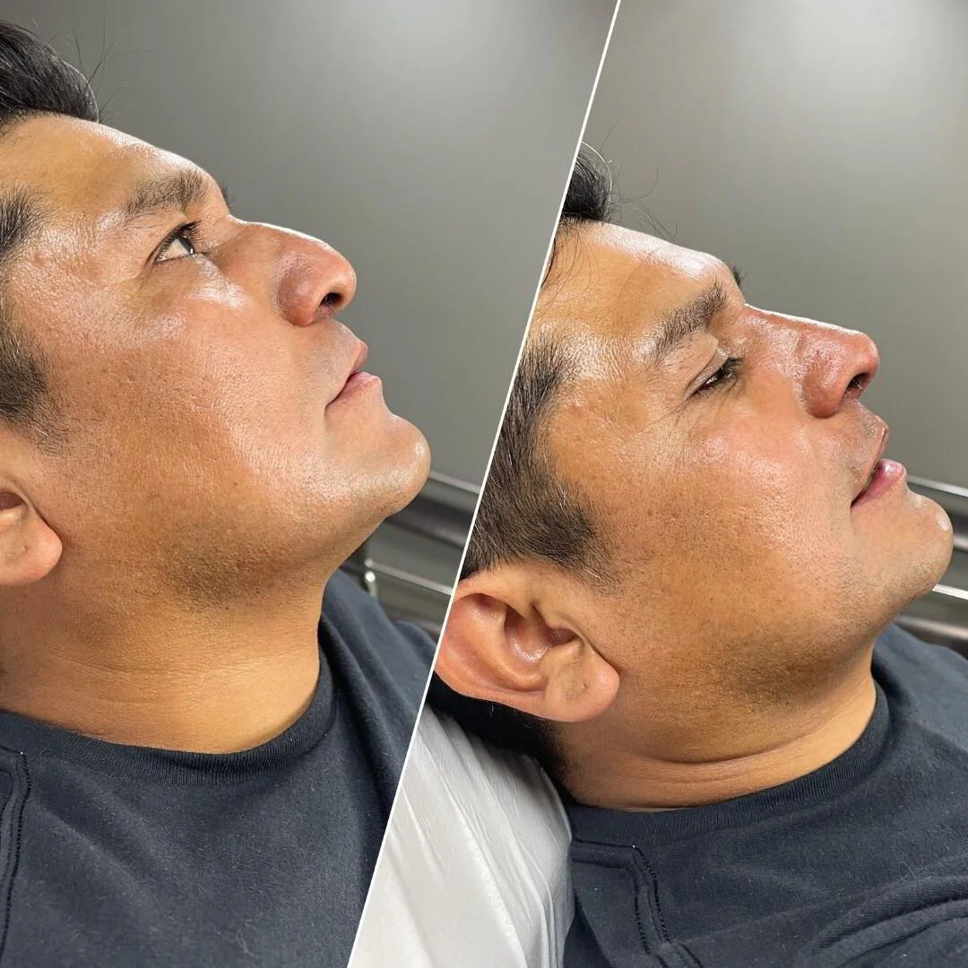 rino-antes-y-depues-6